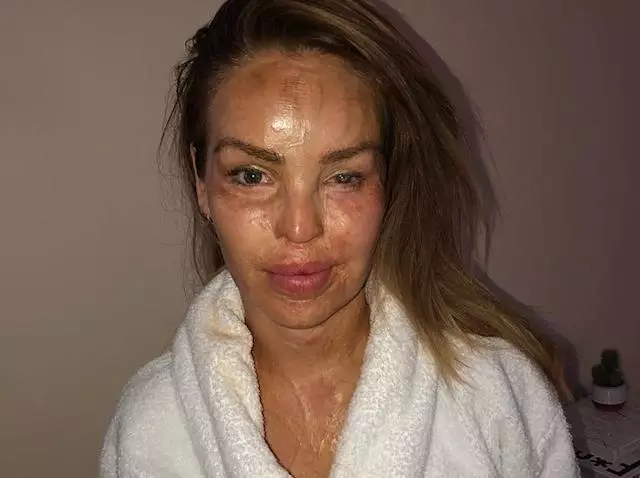 katie piper before and after